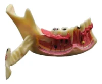Modelo Dental Hemimandíbula Desmontable.